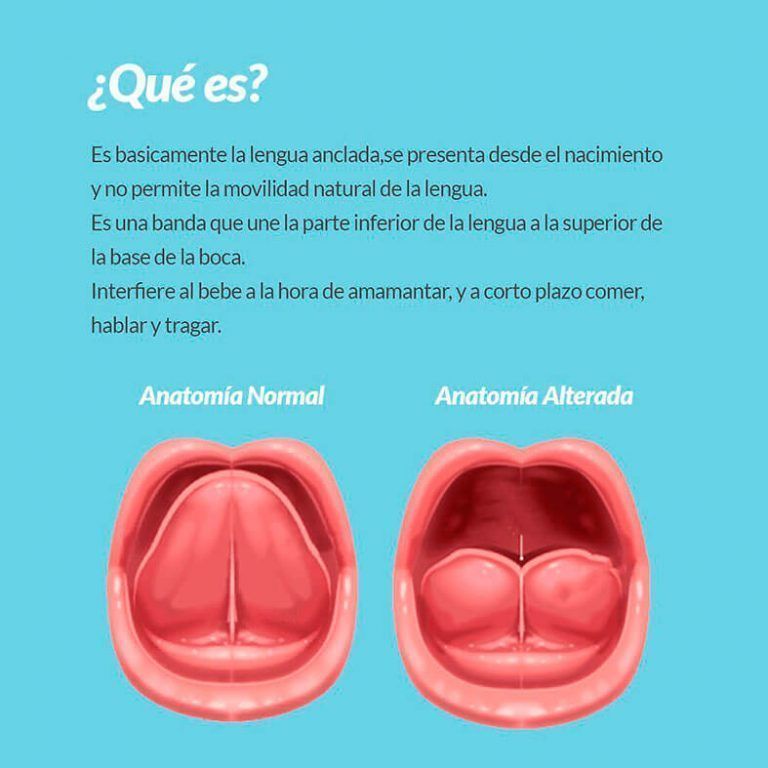 Frenillo Lingual